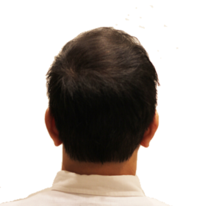 MとO、両方から進行する薄毛に悩む４７歳男性（２）