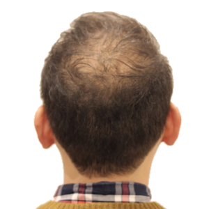 O字・軟毛のお悩みを2回の施術でボリュームアップスタイルに改善ヘア。(外用薬、内服薬の使用無し)