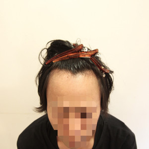 【自毛植毛】〜FUE法〜手術後1ヶ月のヘアスタイル提案
