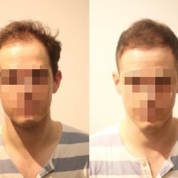 頭頂部 薄毛 薄毛に悩む外国人も驚いた ヘアスタイルでこんなに変わる Inti Report 薄毛に悩む男性の為の美容院 Inti インティ 全席個室 東京 大阪 福岡に展開