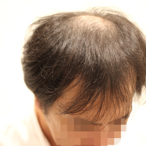 【薄毛　カット】前頭部（M）と頭頂部（O）が同時に薄くなってきたヘアスタイルをデザインする。