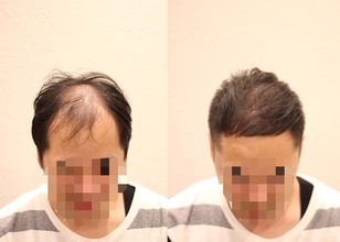 【原因　薄毛】薄毛の原因はヘアデザインにあった!!!!?