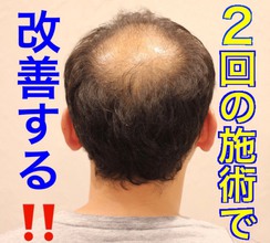 【AGA　頭頂部】O字のお悩みを2回の施術でボリュームスタイルに改善する!!