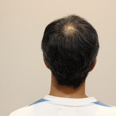 O字型 薄毛 お客様が実際に使用中の育毛剤で本当に効果を感じている薬とは Inti Report 薄毛に悩む男性の為の美容院 Inti インティ 全席個室 東京 大阪 福岡に展開 O字型 薄毛 お客様が実際に使用中の育毛剤で本当に効果を感じている薬とは Inti Report 薄毛に悩む男性の為の美容院 Inti インティ 全席個室 東京 大阪 福岡に展開
