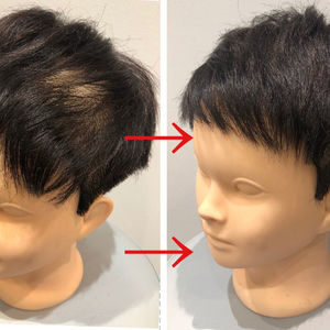 【円形脱毛症　改善方法】毛流れをカットで変えることが薄毛カバーの鉄則