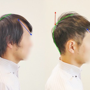 【M字　髪型】M字型薄毛をカバーするスタイルの比較と解説