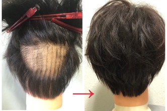 【植毛後　Ⅿ字】ヘアシート不要、NEWスタイル提案！