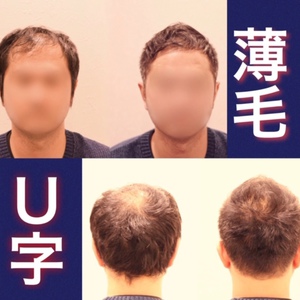 【U字　髪型】U字型薄毛カバーのスタイル比較と解説
