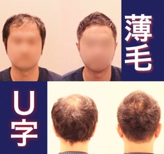 【U字　髪型】U字型薄毛カバーのスタイル比較と解説