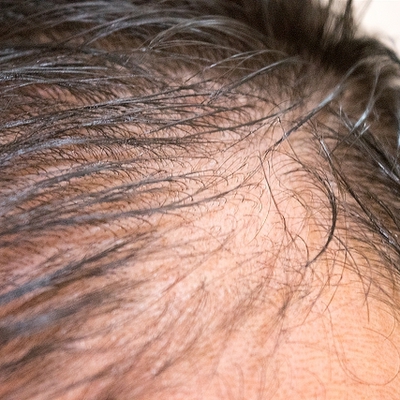 頭皮 皮脂 頭皮のベタつきでより薄毛に見える Inti Report 薄毛に悩む男性の為の美容院 Inti インティ 全席個室 東京 大阪 福岡に展開 頭皮 皮脂 頭皮のベタつきでより薄毛に見える Inti Report 薄毛に悩む男性の為の美容院 Inti インティ 全席個室 東京 大阪 福岡に展開