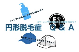 【円形脱毛症　気になる】聞けない、調べてもわからない、円形脱毛症Q＆A