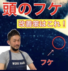 【薄毛・フケ】気になる頭皮の白い粉のような物！これって薄毛のサイン？