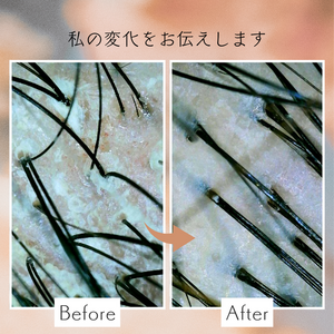 【薄毛 頭皮ケア】脂漏性湿疹で抜け毛が増えた私の頭皮が改善するまで