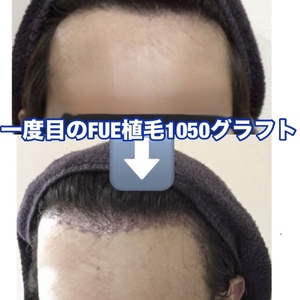 植毛(FUE)の気になる剃毛範囲のリアルリポート