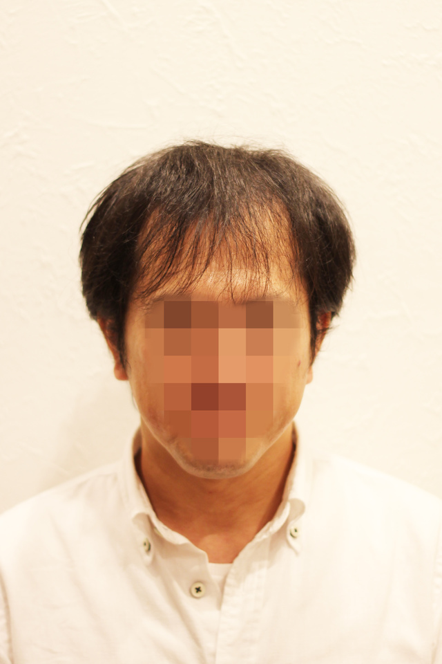 薄毛 男 頭頂部 髪型 【薄毛男性のヘアスタイル14選】カッコよくなる5つのポイント