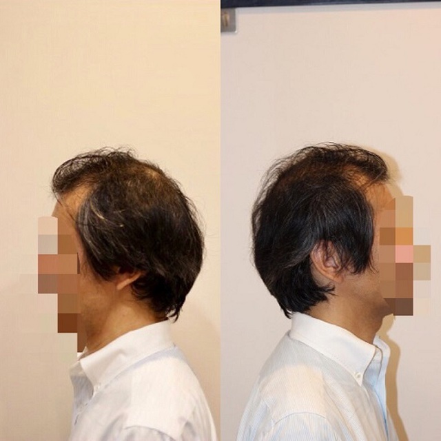 薄毛 髪型 薄毛をカバーするだけでなくライフスタイルにマッチしたヘアデザイン提案 Inti Report 薄毛に悩む男性 の為の美容院 Inti インティ 全席個室 東京 大阪 福岡に展開