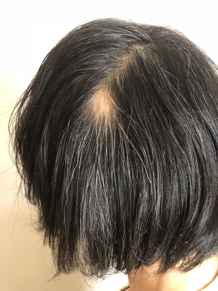 脱毛 いけない て 円形 し 症 こと は 円形脱毛症を繰り返す６つの原因は？対処法や治療法を紹介！
