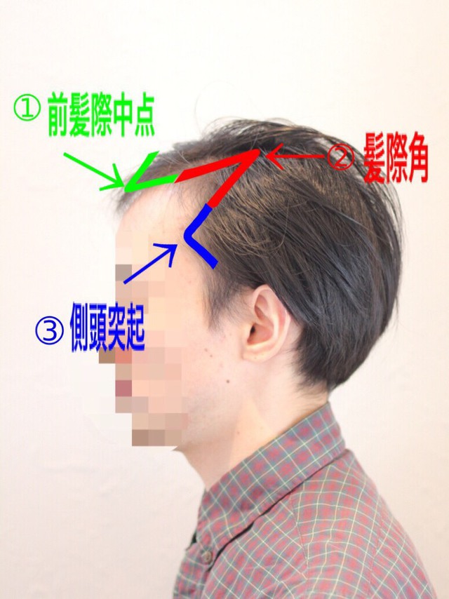 M字 パーマ 実態報告 前髪が長くても割れない方法 パーマ実例 Inti Report 薄毛に悩む男性の為の美容院 Inti インティ 全席個室 東京 大阪 福岡に展開