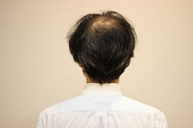 薄毛 髪型 薄毛をカバーするだけでなくライフスタイルにマッチしたヘアデザイン提案 Inti Report 薄毛に悩む男性 の為の美容院 Inti インティ 全席個室 東京 大阪 福岡に展開