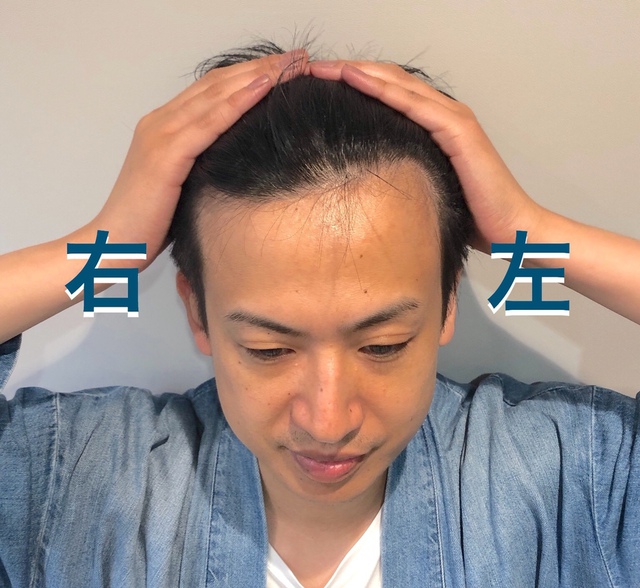 ｍ字 前髪 自分の生え際を分析して前髪カットをオーダーしてみよう Inti Report 薄毛に悩む男性の為の 美容院 Inti インティ 全席個室 東京 大阪 福岡に展開