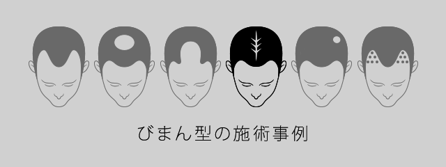 びまん型の施術事例