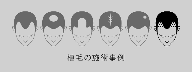 植毛の施術事例